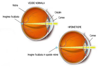 miopie și hipermetropie minus și plus)