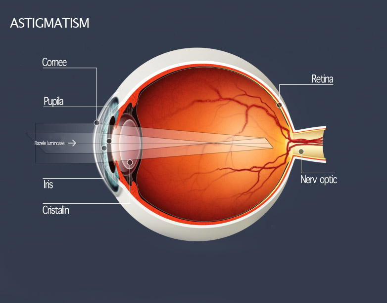cum se vindecă miopia cu astigmatism)