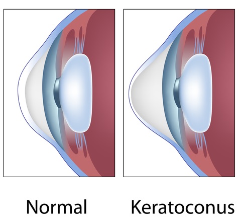keratoconus de vedere viziune și hipotiroidism